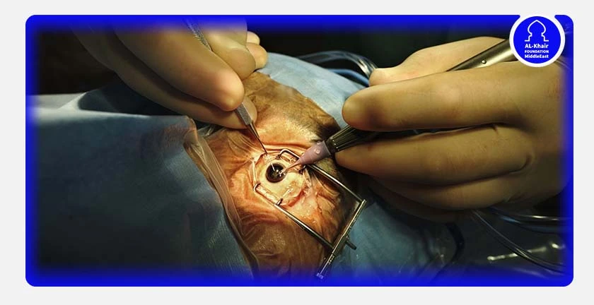 عمليات العيون "مرض الساد"